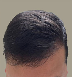 hair transplant photos