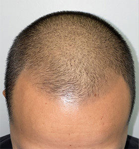 hair transplant photos