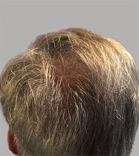 hair transplant photos