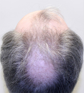 hair transplant photos