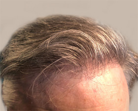 hair transplant photos