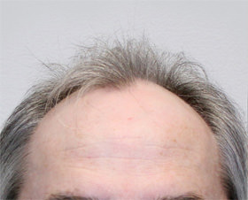 hair transplant photos