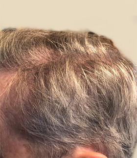 hair transplant photos