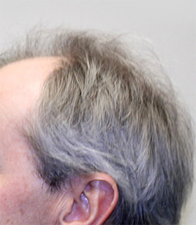 hair transplant photos