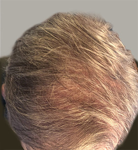 hair transplant photos