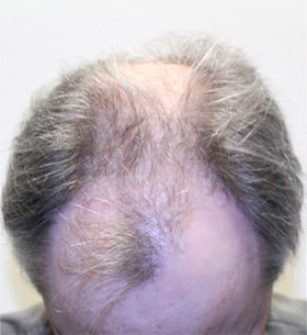 hair transplant photos