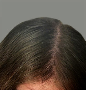 hair transplant photos