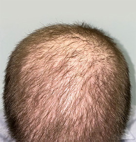 hair transplant photos