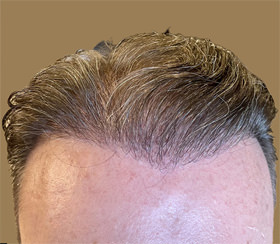 hair transplant photos