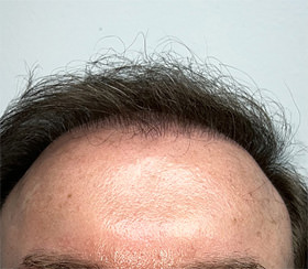 hair transplant photos