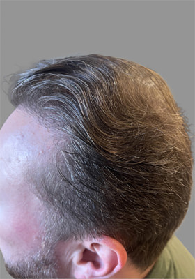 hair transplant photos