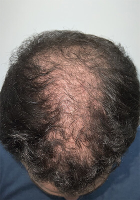 hair transplant photos