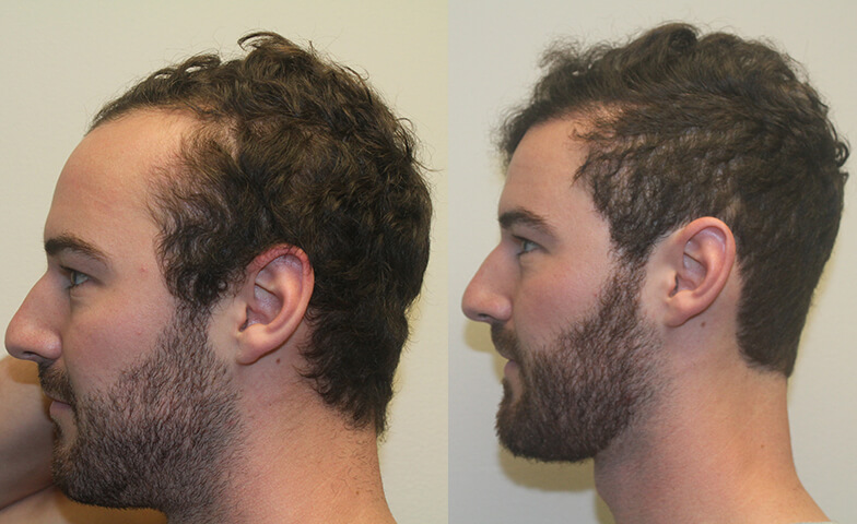 Great Hair Transplants Patient Casey Page Dr Brett Bolton