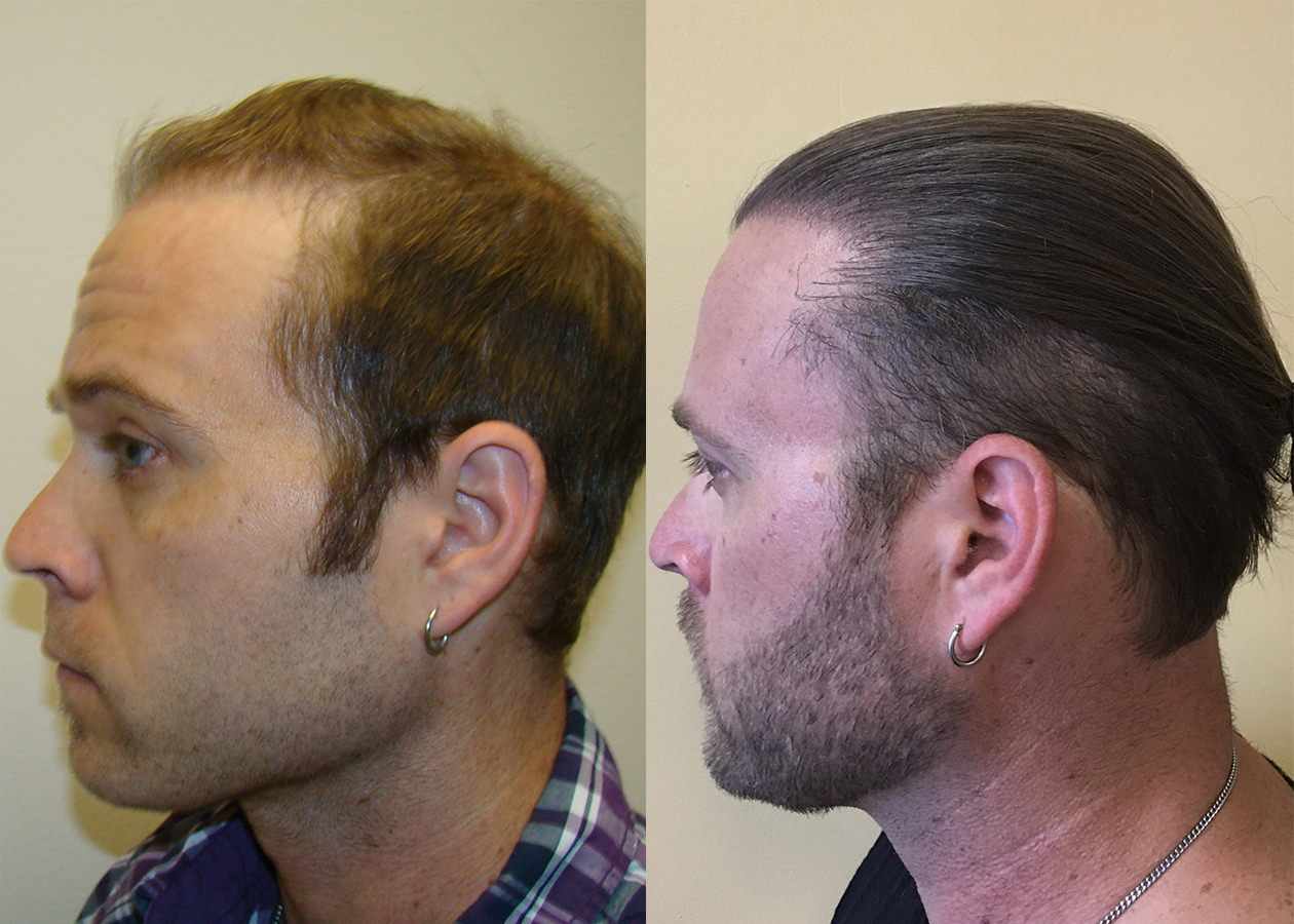 Hair Transplant Results - wide 5