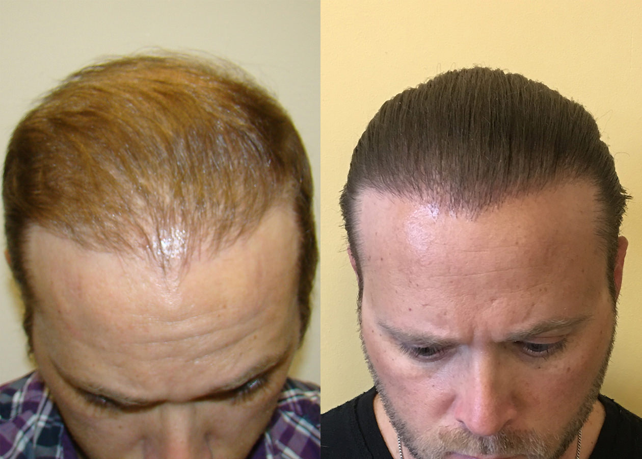 fine blonde hair transplant