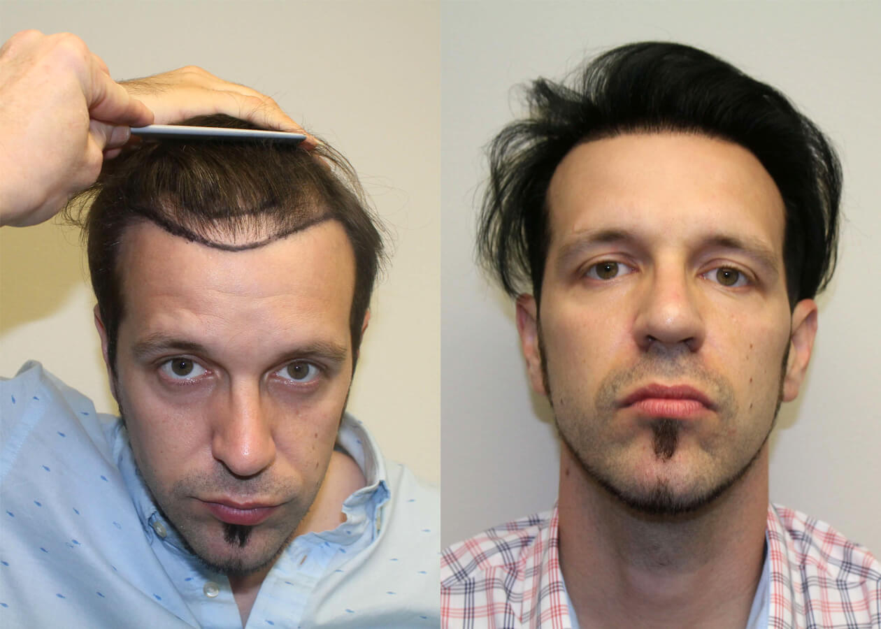 Great Hair Transplants Patient Andy Page Dr Brett Bolton