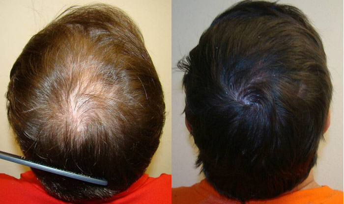 Brian H Hair Transplant Repair