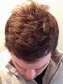 hair transplant photos