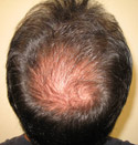 Hair Transplant Patient Photos