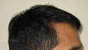 Hair Transplant Patient Photos