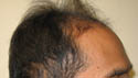 Hair Transplant Patient Photos