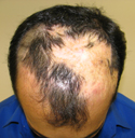 cicatricial alopecia