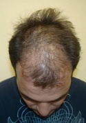 difuse pattern alopecia