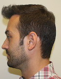 Hair Transplant Images 