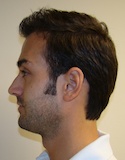 Hair Transplant Images 