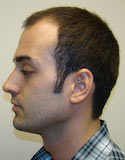 Hair Transplant Images 