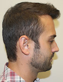 Hair Transplant Images 