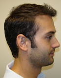 Hair Transplant Images 