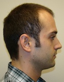 Hair Transplant Images 