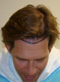 hair transplant photos