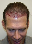 hair transplant photos