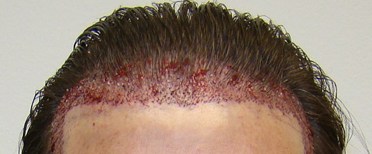 Hair Transpant Patient Photos