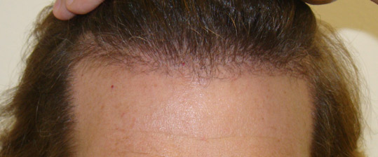 Hair Transpant Patient Photos