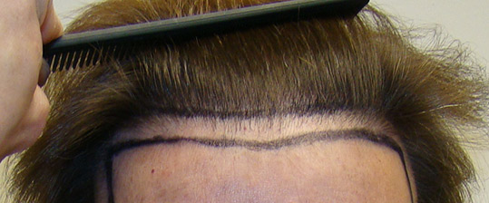 Hair Transpant Patient Photos