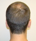 Hair Transplant Images 