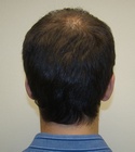 Hair Transplant Images 