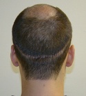 Hair Transplant Images 