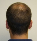 Hair Transplant Images 