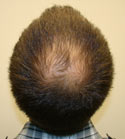 Hair Transplant Images 