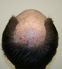 Hair Transplant Images 