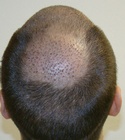 Hair Transplant Images 