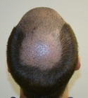 Hair Transplant Images 