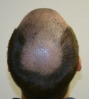 Hair Transplant Images 