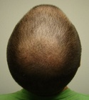 Hair Transplant Images 