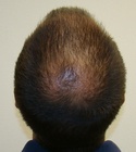 Hair Transplant Images 