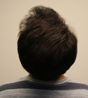 Hair Transplant Images 